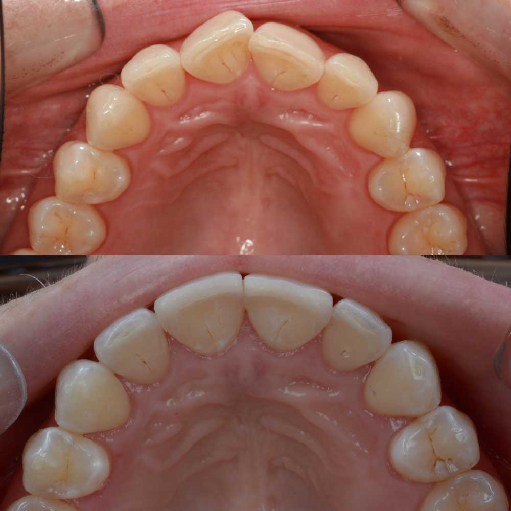 caso invisalign 4