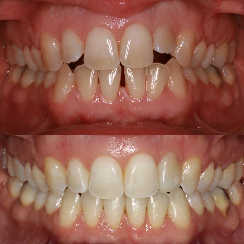 caso invisalign 1