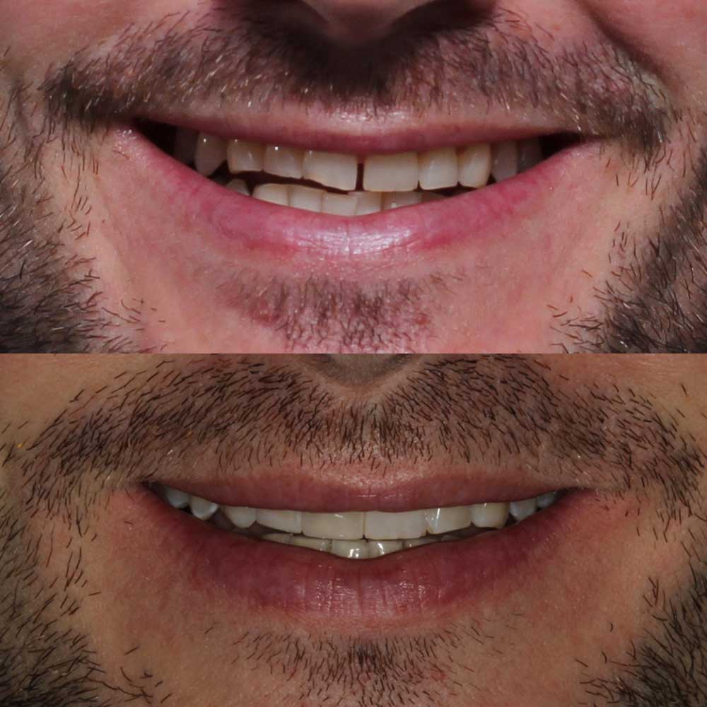 Caso invisalign 2