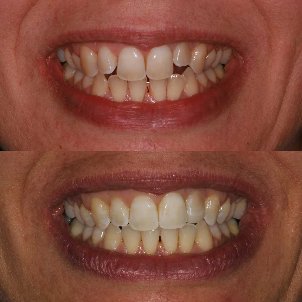 caso invisalign 5