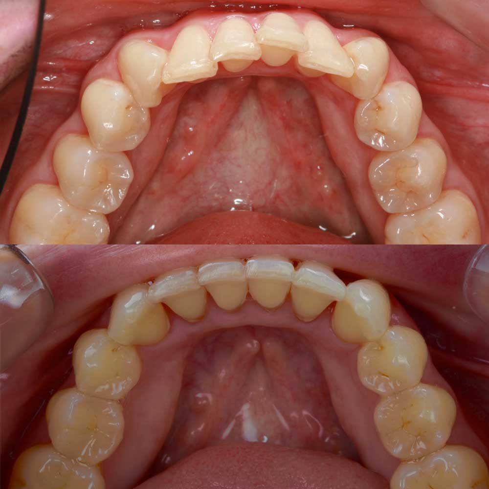 caso invisalign 3